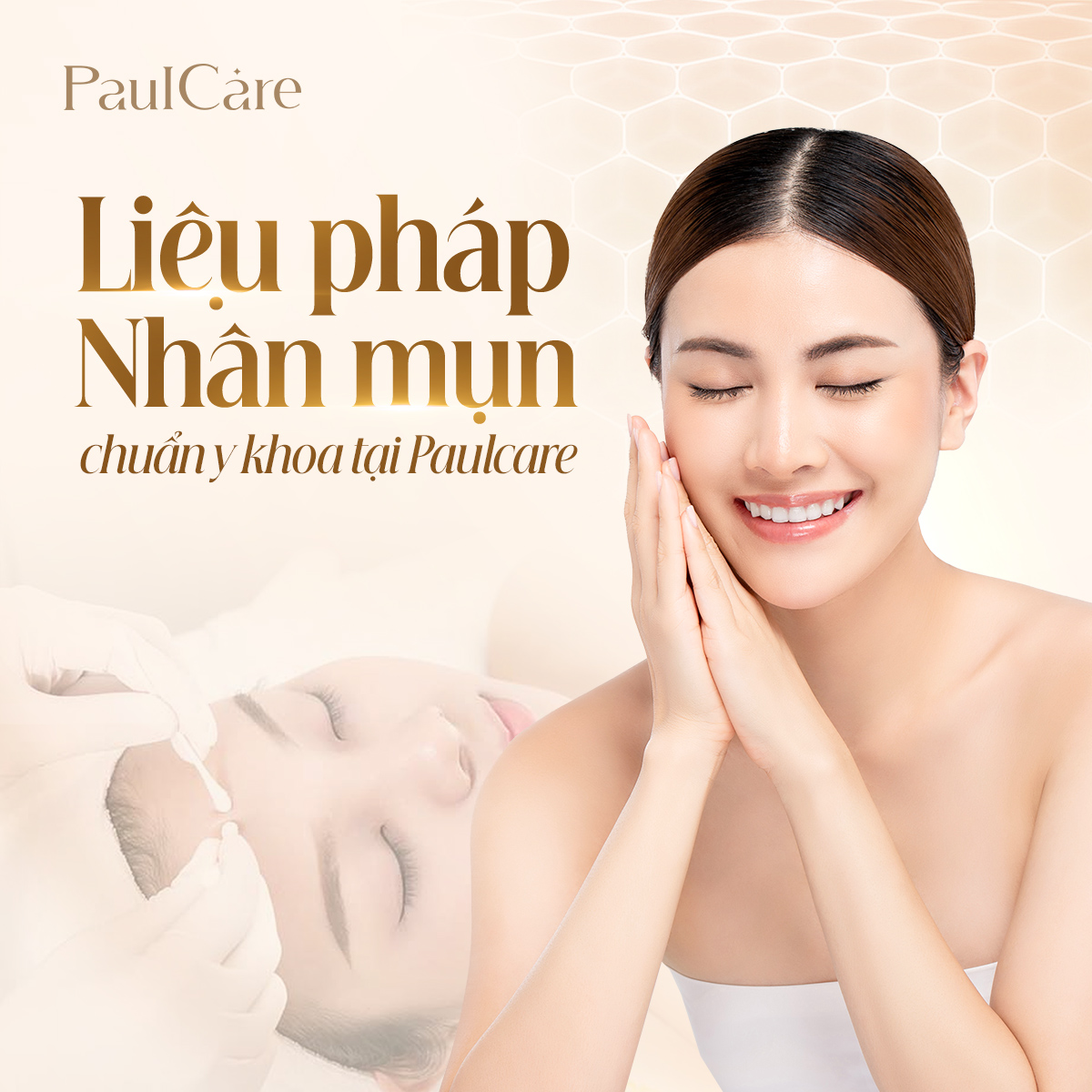 Lieu_phap_lay_nhan_mun_chuan_y_khoa_PaulCare