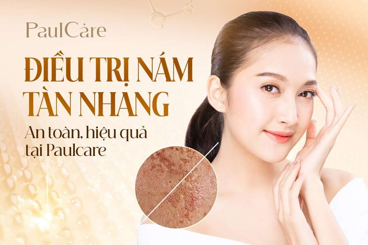 dieu_tri_nam_tan_nhang_PaulCare