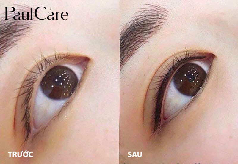 phun-mi-mat-mo-trong_paulcare